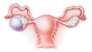 Cysts_and_Ovarian_Cancer