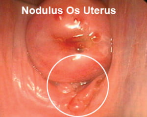 Nodulus Os Uterus