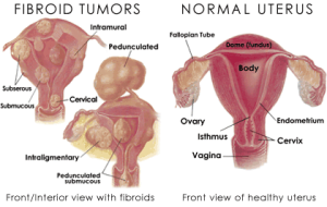 fibroid-tumors
