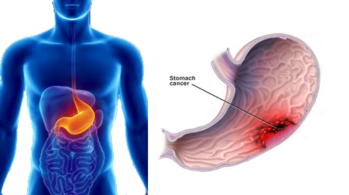 পাকস্থলী ক্যান্সারের চিকিৎসা