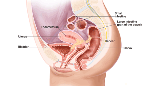 স্ত্রী-জননাঙ্গের ক্যান্সার, Female Genitalia Cancer