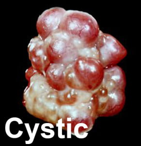 cystic1