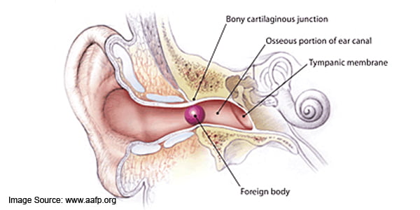 কানে কিছু ঢুকে গেলে করণীয় (Foreign Body in the Ear):