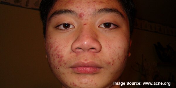 ব্রণের চিকিৎসা (Acne) ও প্রতিরোধ (২৭৬ রুব্রিক ও ভিডিও টিউটোরিয়াল সহ)