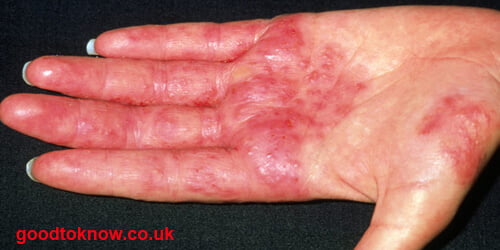 ত্বক প্রদাহের (Dermatitis) চিকিৎসা