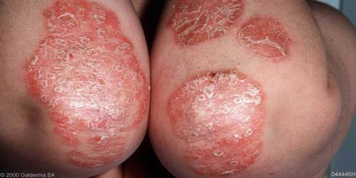 সোরিয়াসিস (Psoriasis) কি? ও সোরিয়াসিস চিকিৎসা।